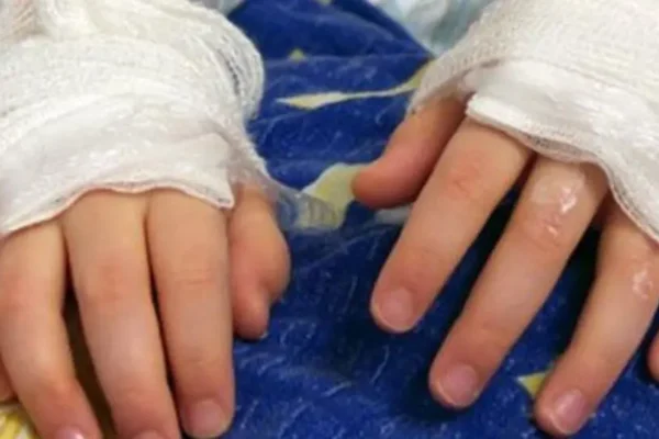 Hombre prende fuego a su hijo en Viacha; cuatro personas resultan quemadas